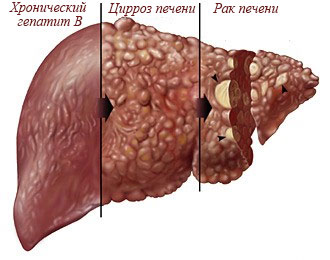 Гепатит б количественный анализ